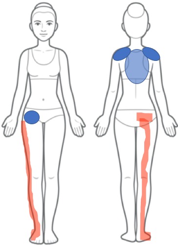 臀部〜足全体の痺れ・痛み