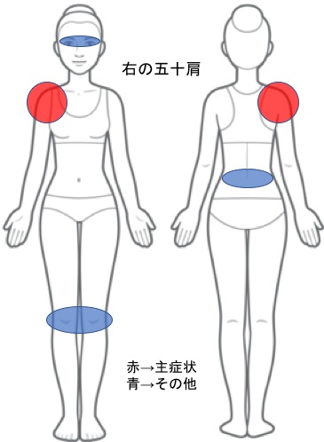 五十肩（肩関節周囲炎）