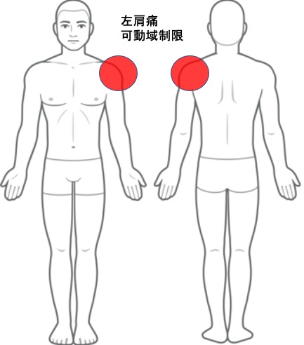 左肩の痛み、五十肩