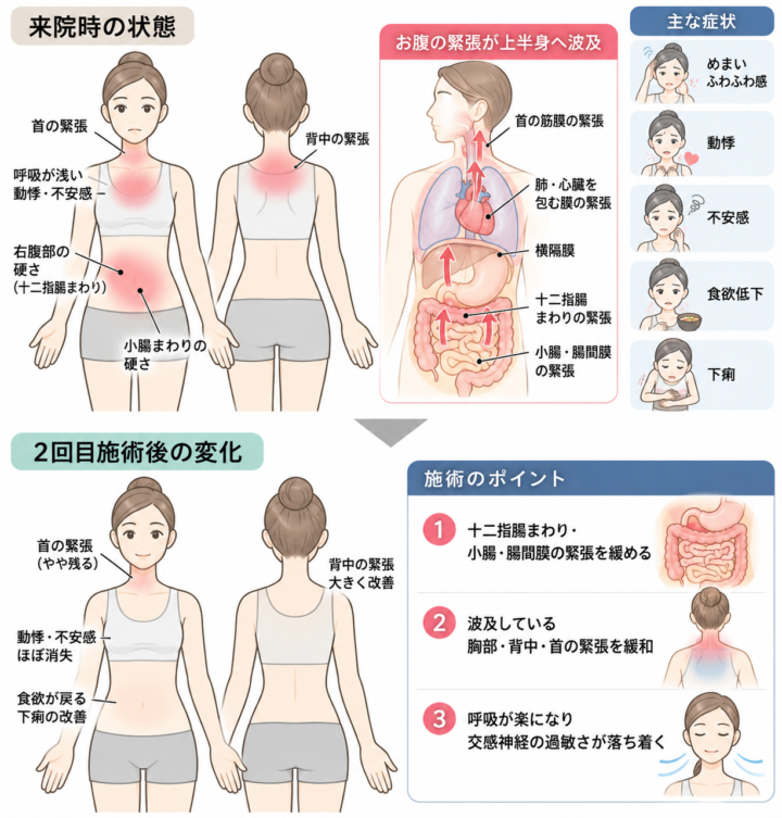 十二指腸炎後のめまい・動悸・不安感